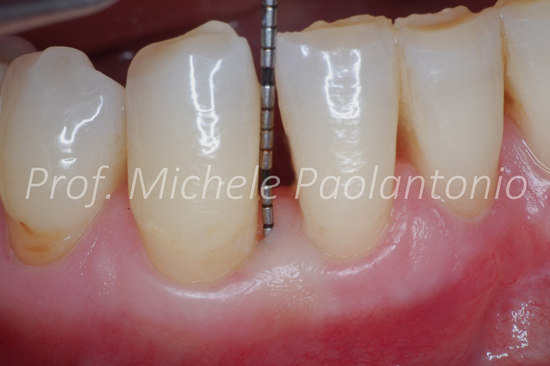 Terapia Parodontale Chirurgica: Come Rigenerare il Sorriso